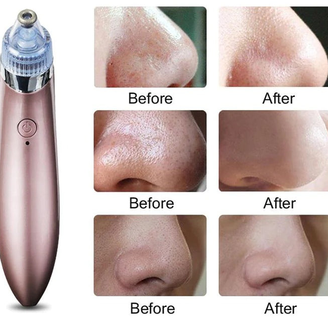 "GlowSkinβ’ Portable Blackhead Remover"
